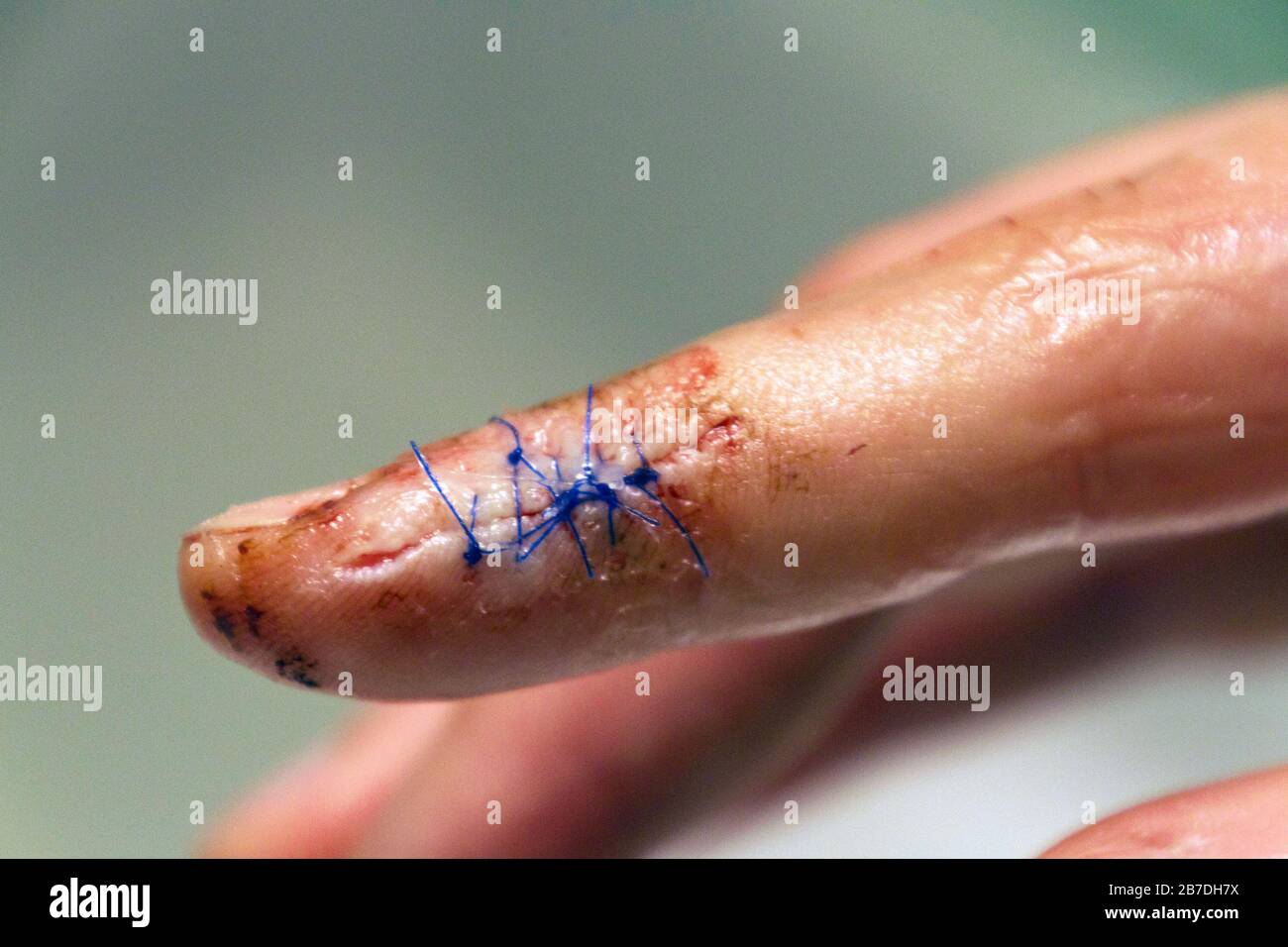 Nahaufnahme eines gezogenen Fingers mit blutigen Stichen, die einen langen, tiefen Schnitt am Ende eines Zeigefingers abschließen Stockfoto