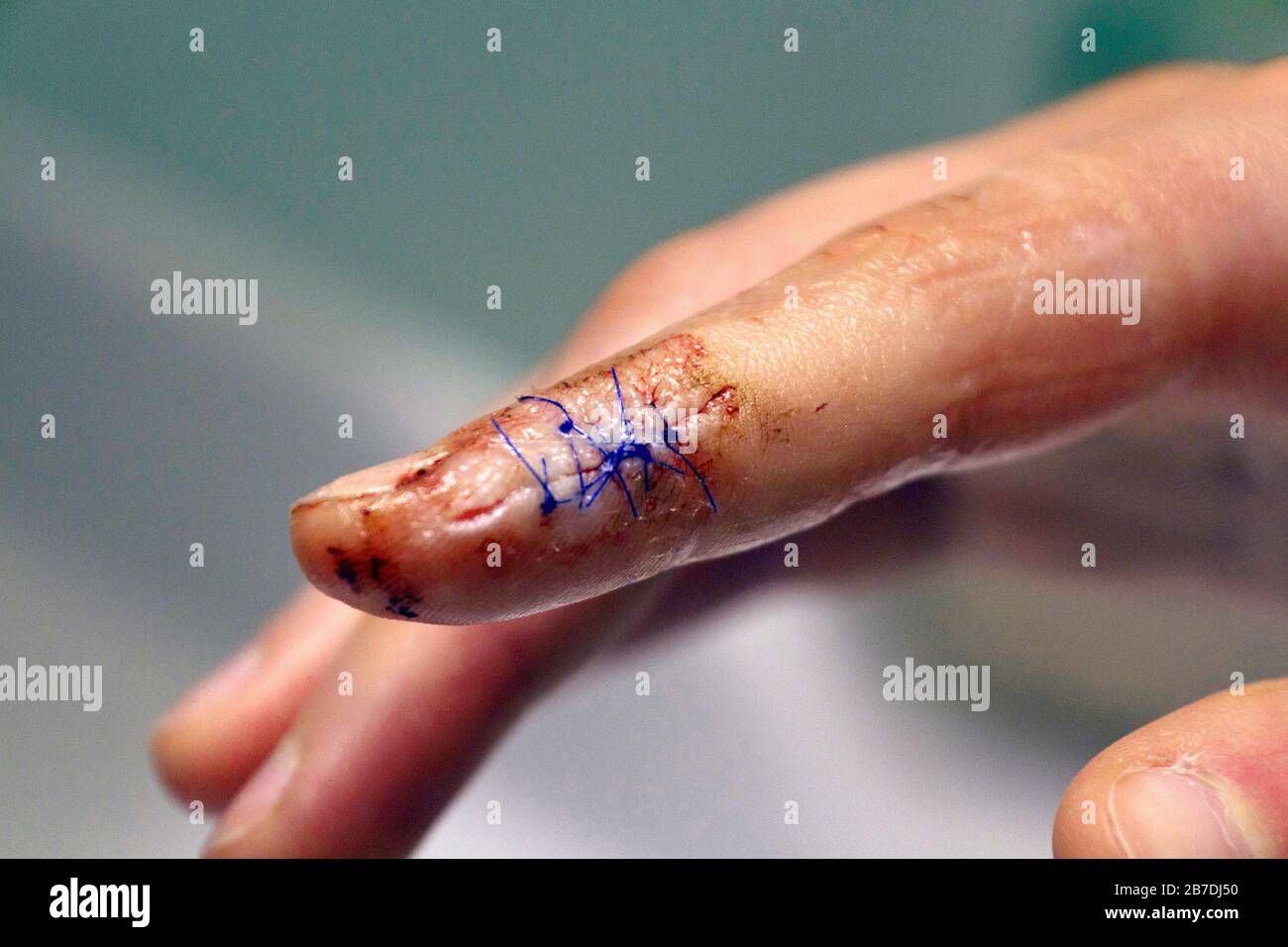 Nahaufnahme eines gezogenen Fingers mit blutigen Stichen, die einen langen, tiefen Schnitt am Ende eines Zeigefingers abschließen Stockfoto
