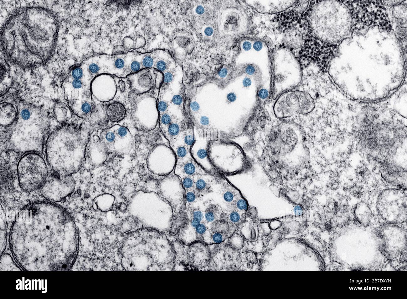Transmissionselektronenmikroskopisches Bild eines Isolats vom ersten US-Fall von COVID-19, früher bekannt als 2019-nCoV. Die blau gefärbten kugelförmigen Viruspartikel enthalten Querschnitte durch das virale Genom, die als schwarze Punkte angesehen werden. Credit: UPI/Alamy Live News Stockfoto