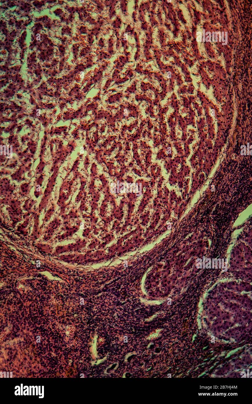 Erkrankte Leber mit Zirrhose 100x unter dem Mikroskop Stockfoto