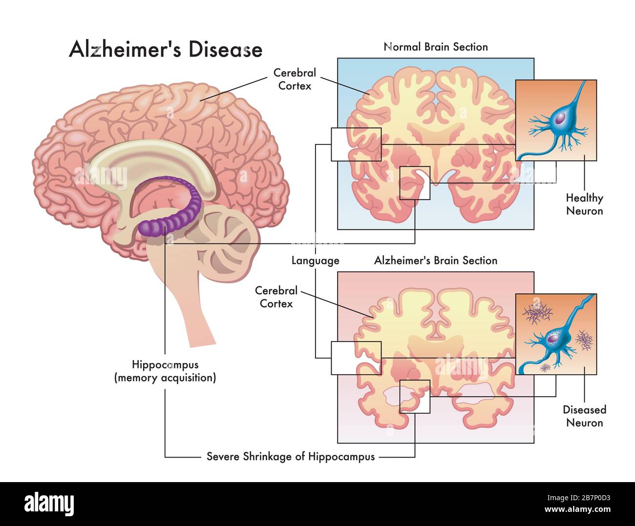 Medizinische Illustration der Alzheimer-Krankheit isoliert auf weiß. Stockfoto