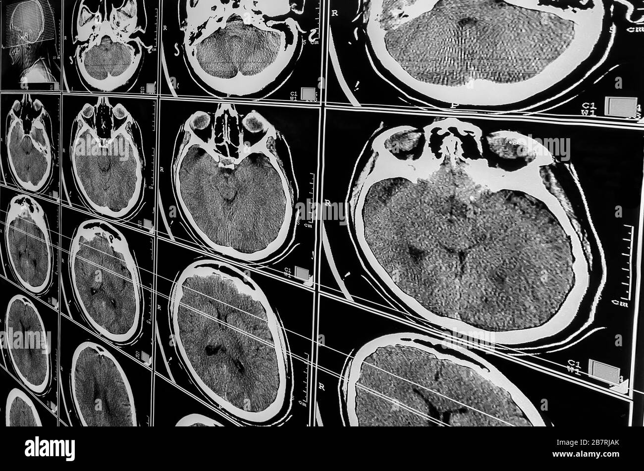 Elektromagnetische Tomographie Gehirn. Sequenz vertikaler Abschnitte eines menschlichen Gehirns - MRT-Messung. Echte Hirn-MRT-Folie eines Mädchens. Minimale Bearbeitung zum Speichern Stockfoto
