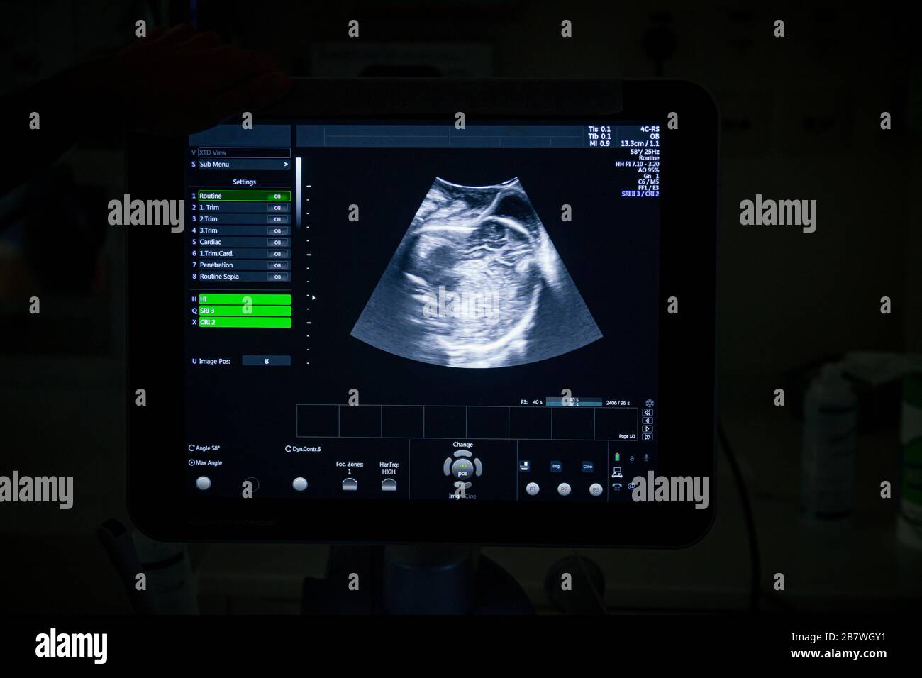 Medizinisches Ultraschallgerät mit einem 4D-Bild in einem Labor- und Auslieferungsraum in einem Krankenhaus. Stockfoto
