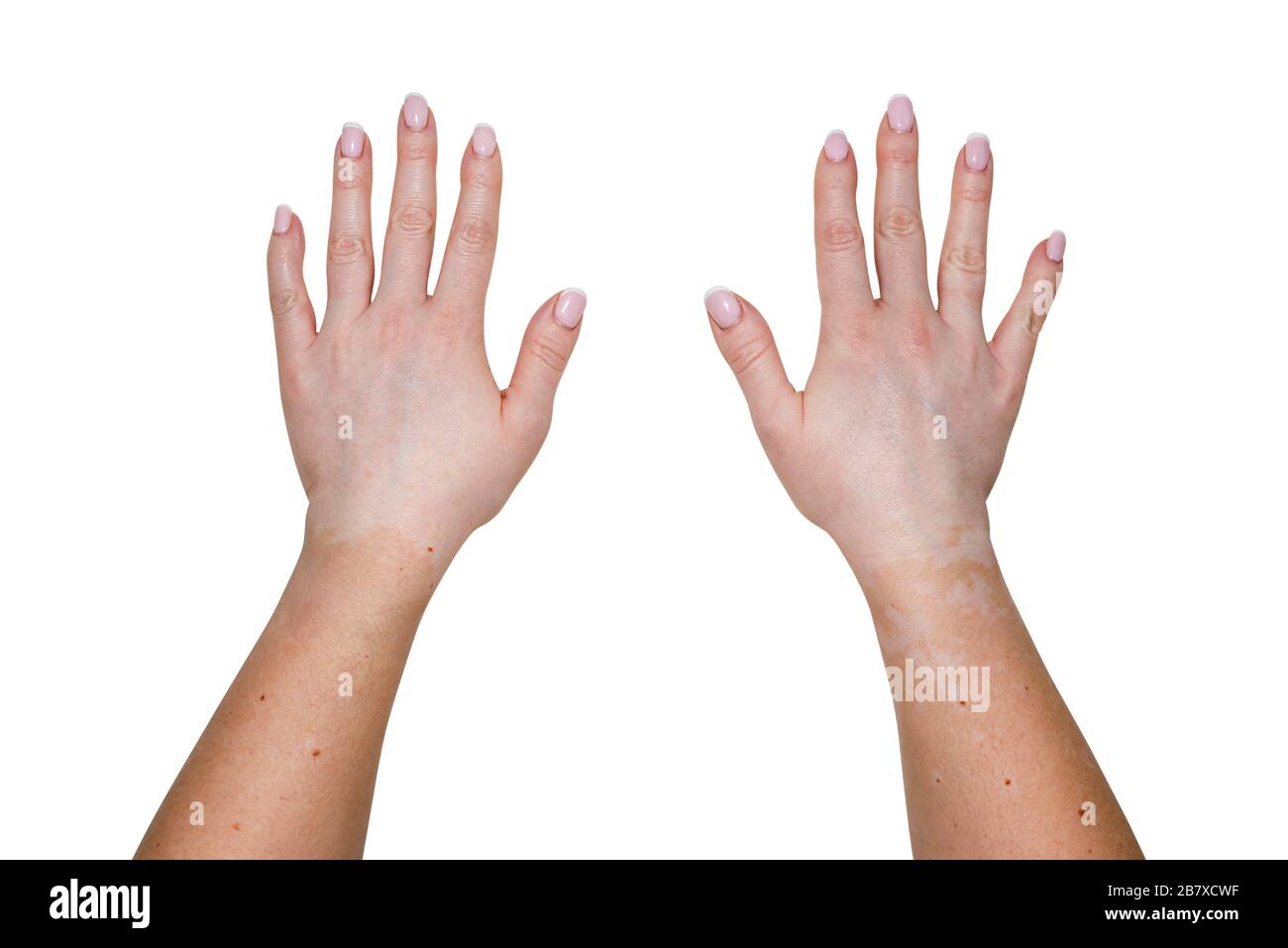 Flecken von Vitiligo an den äußeren Handteilen einer jungen kaukasischen Frau, isoliert auf weißem Grund mit einem Beschneidungspfad. Stockfoto