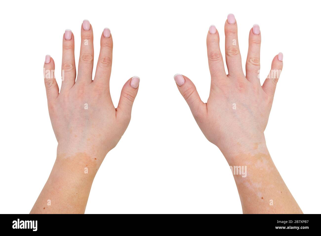 Flecken von Vitiligo an den äußeren Handteilen einer jungen kaukasischen Frau, isoliert auf weißem Grund mit einem Beschneidungspfad. Stockfoto