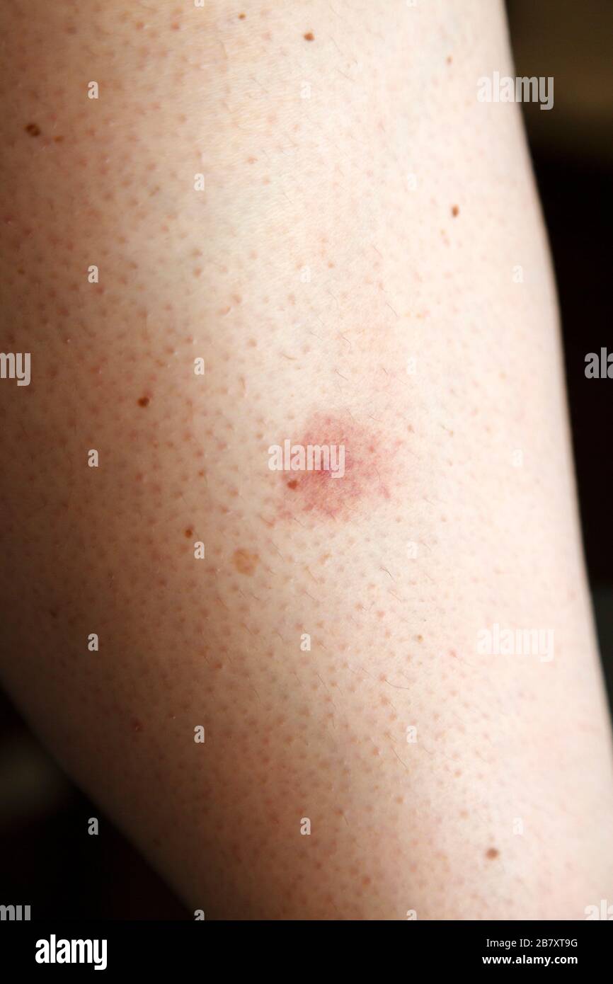 Kindergesundheit Lymphangitis Roter Streifen Nach Insektenstich Cleankids Magazin