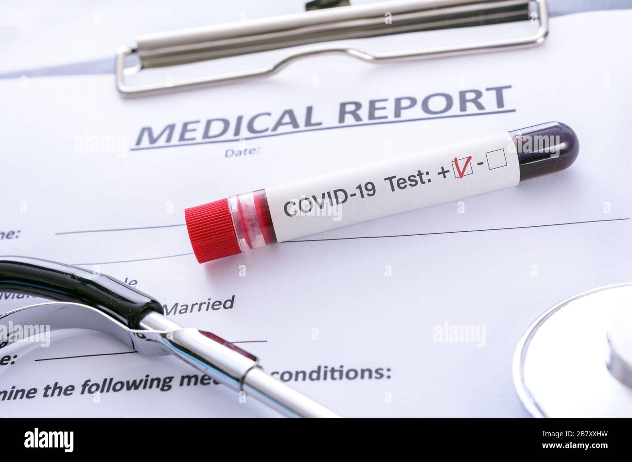 Infektiöses Konzept des Coronavirus - positiver Test des Blutproben-VID -19 auf medizinischen Dokumentationsunterlagen im Labor Stockfoto