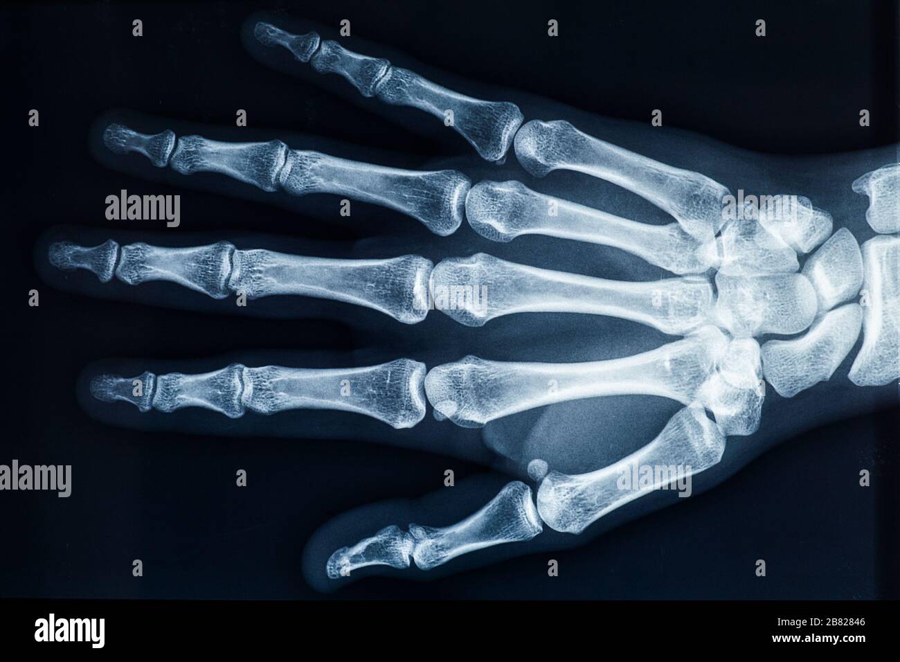 Röntgenbild der weiblichen rechten Knochen von Erwachsenen. Radiographie oder Bildmaterial für medizinische und anatomische Bereiche. Stockfoto