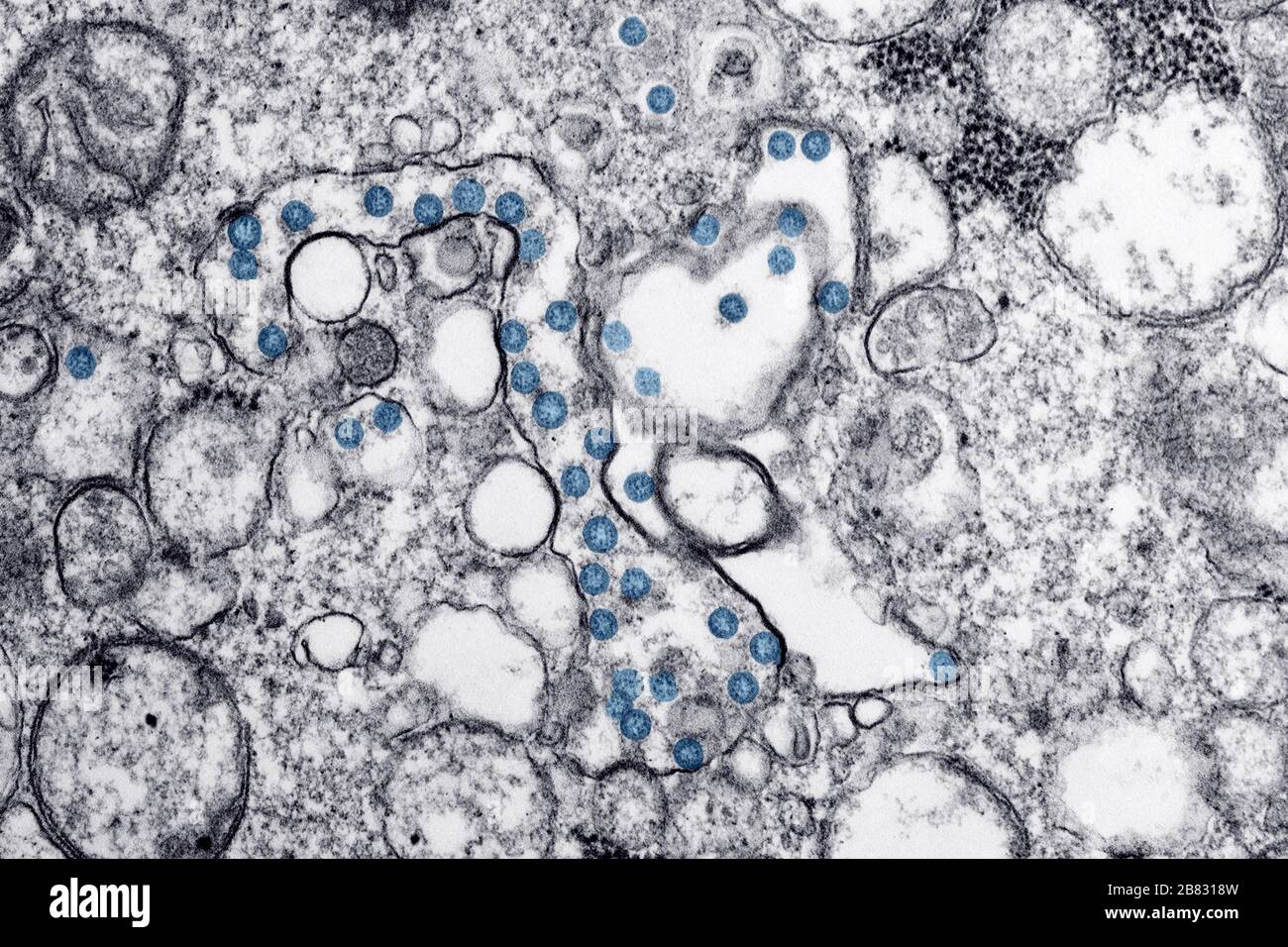 Transmissionselektronenmikroskopie Bild eines Isolats vom ersten US-Fall von COVID-19, früher bekannt als 2019-nCoV, einem Coronavirus, März 2020. Die blau gefärbten kugelförmigen Viruspartikel enthalten Querschnitte durch das virale Genom, die als schwarze Punkte angesehen werden. Bild mit freundlicher Genehmigung CDC/Hannah A Bullock, Azaibi Tamin. () Stockfoto