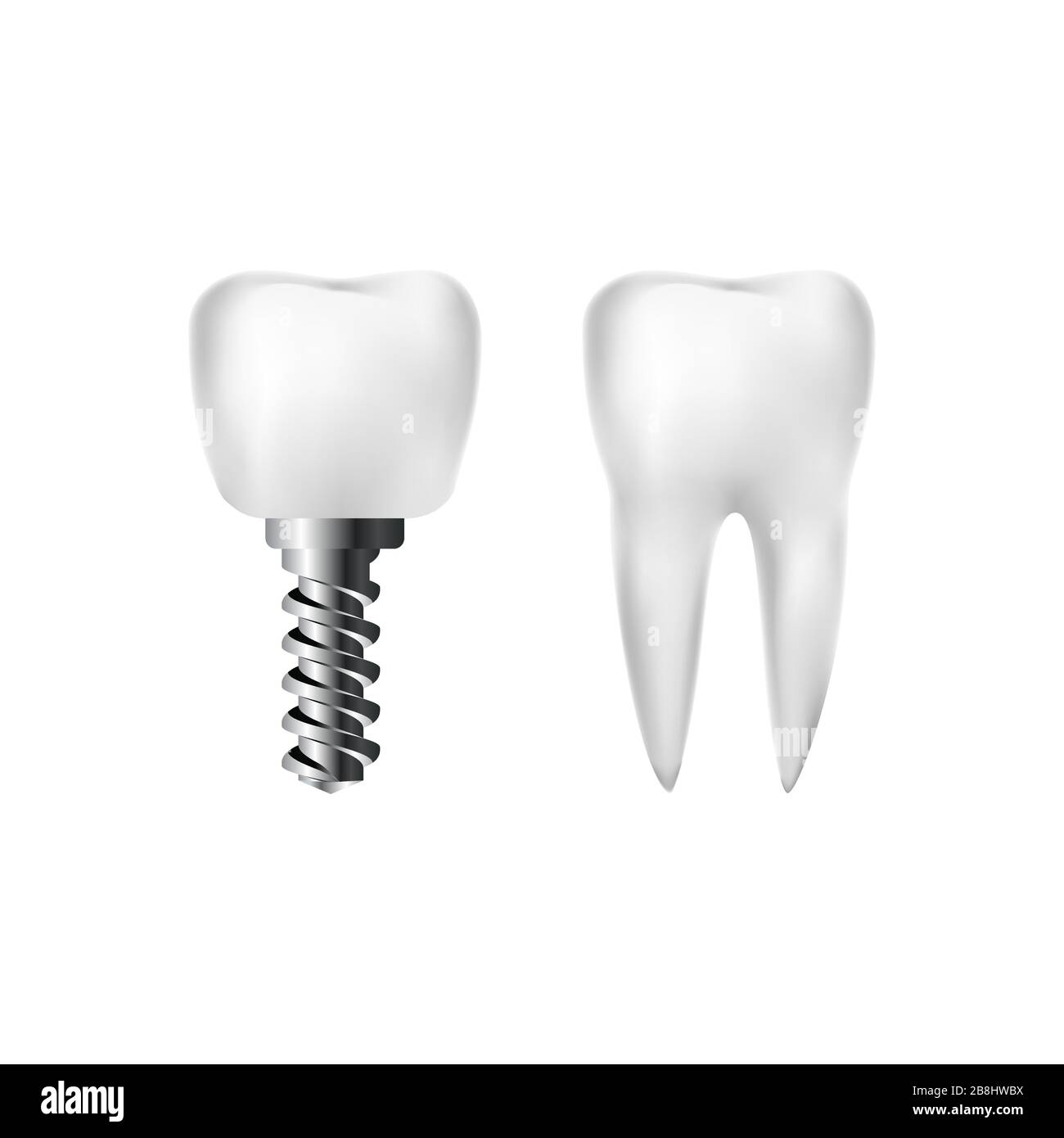 Realistisch gesunder weißer Zahn und Implantat mit Schraube. Zahnmedizin und Zahnarztpflege. Vektor Stock Vektor