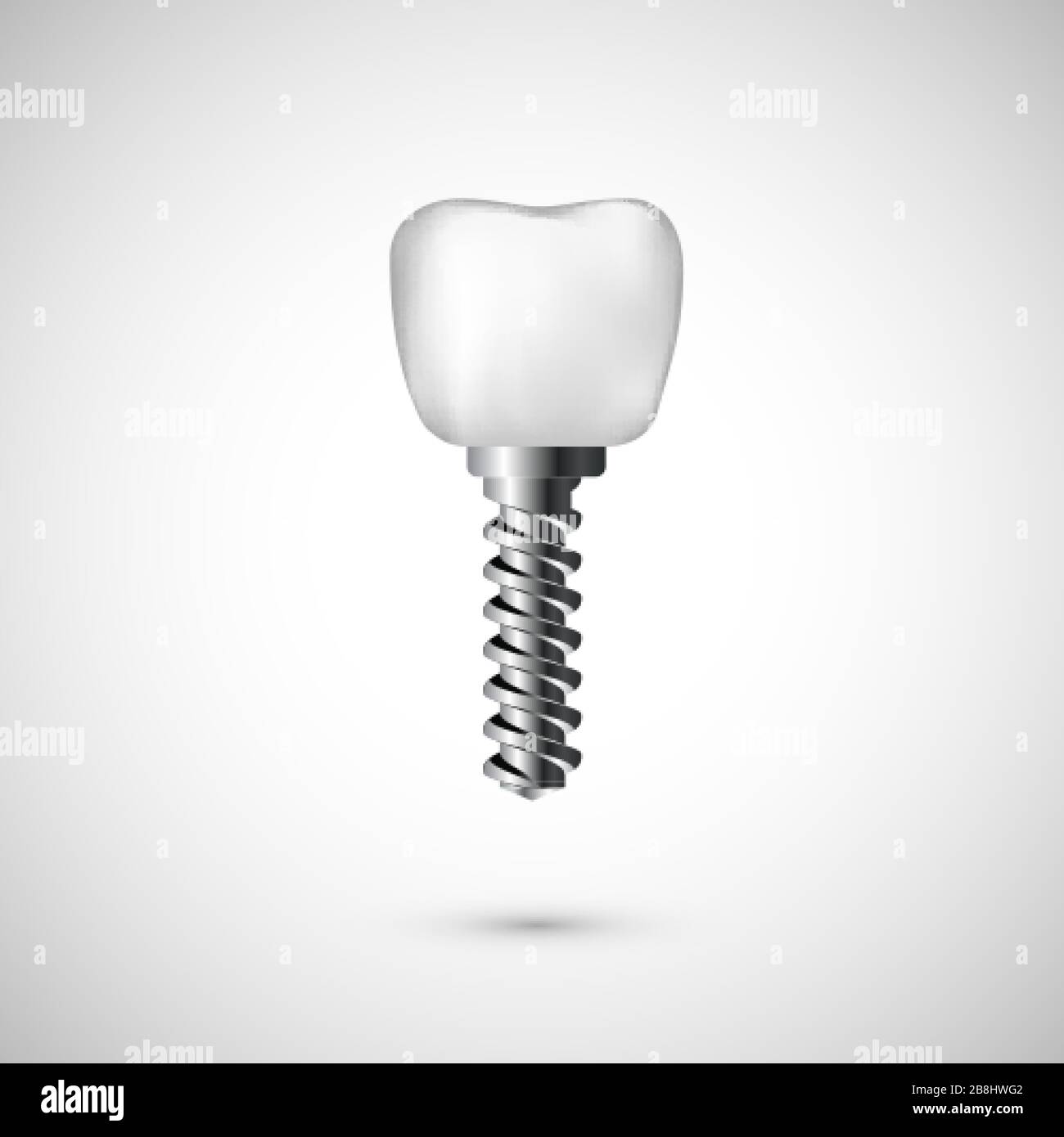 Weiße, realistische Darstellung des Zahnimplantats. Zahnarztpflege und Zahnheilkunde Hintergrund auf weißem Hintergrund. Vektor Stock Vektor