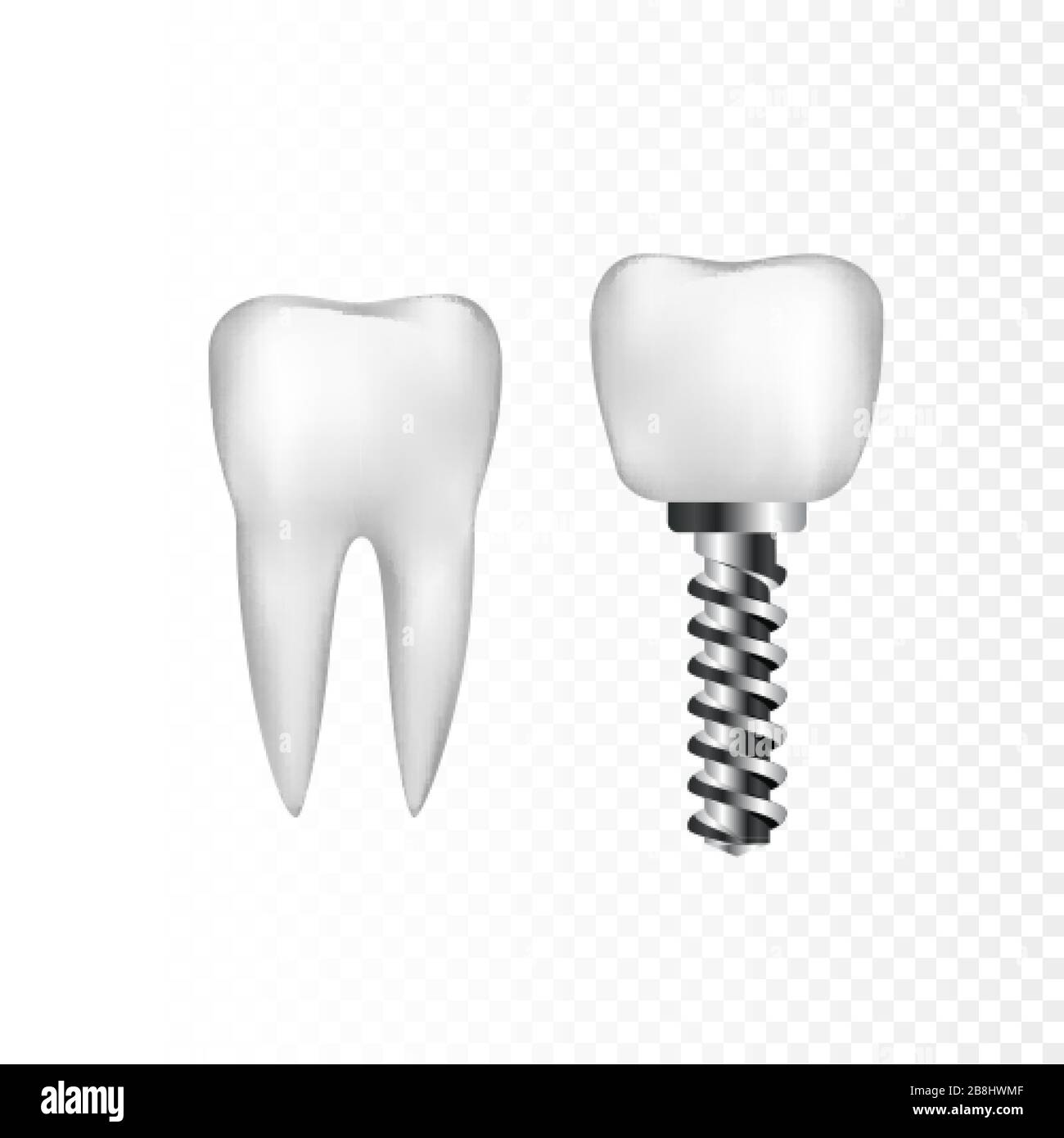 Gesunder weißer Zahn und Implantat mit Stahlschraube. Zahnmedizin und Zahnarztpflege. Vektordarstellung isoliert auf transparentem Hintergrund Stock Vektor