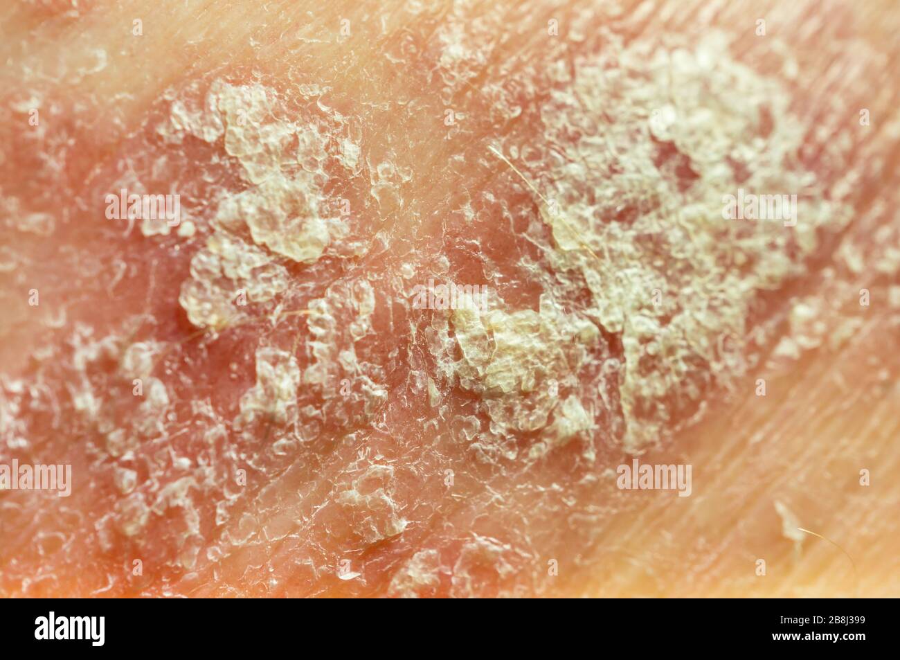 Der Hautzustand eines Patienten mit chronischen Dermatosen - Psoriasis, Ekzem, Dermatitis. Nahaufnahme, weicher Fokus, geringe Schärfentiefe Stockfoto