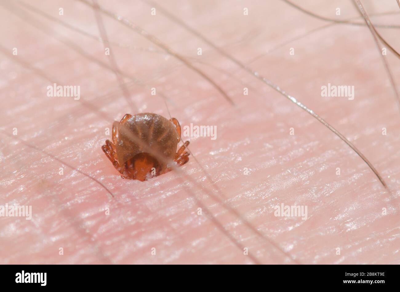 Lone Star Tick, Amblyomma americanum, Nymphe an der menschlichen Haut befestigt Stockfoto