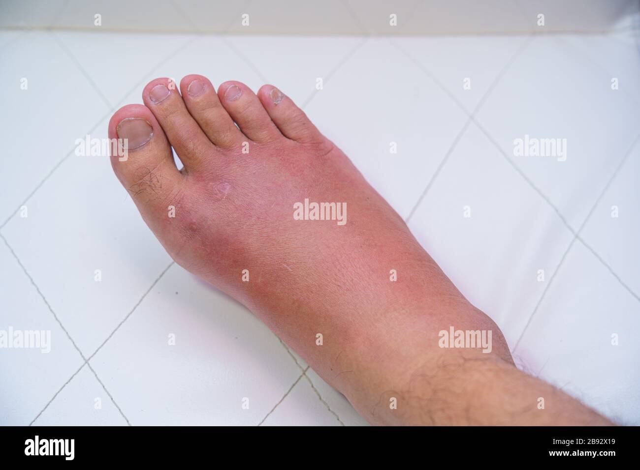 Nahaufnahme des alten Mannes am rechten Fuß, knöchelverwundete Warte und Schwellung Infektionskrankheit durch Bienstich allergische Reaktionen Krankenschwester Behandlung auf Wundverband A Stockfoto