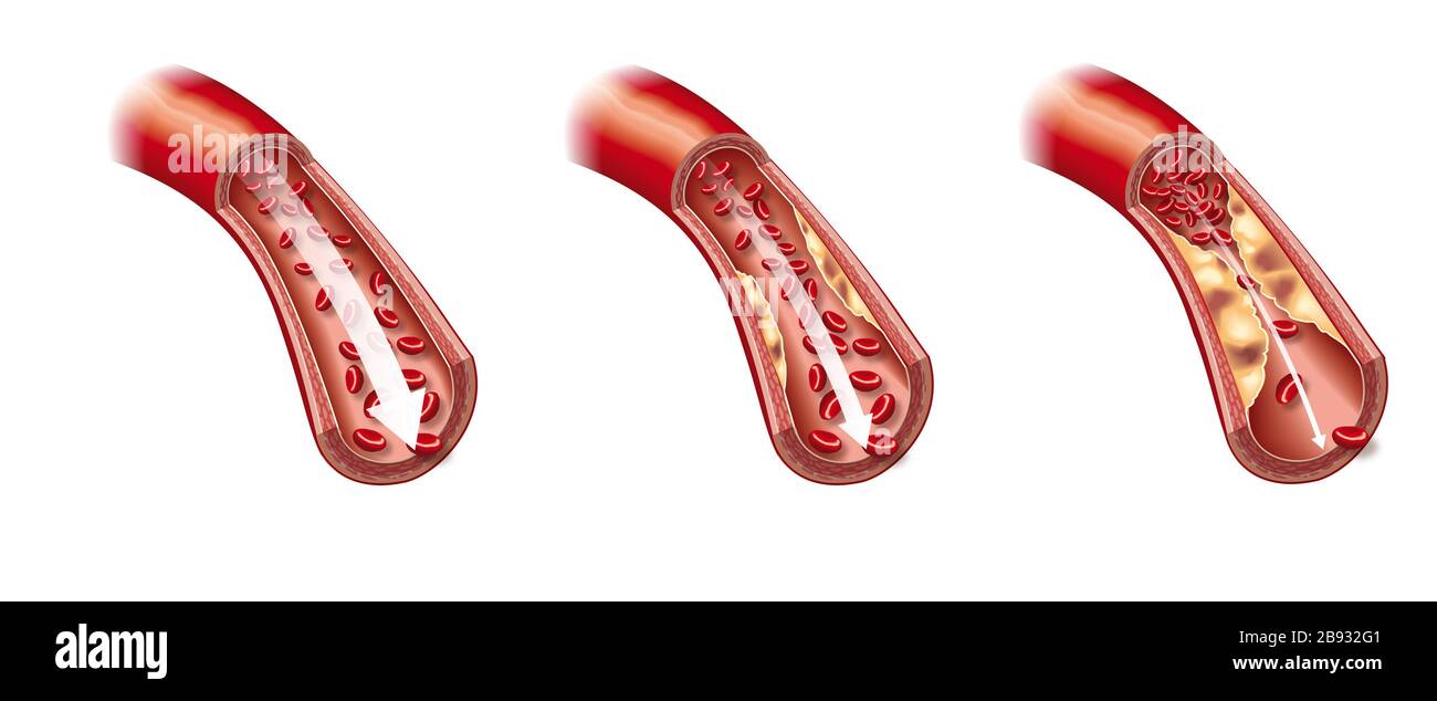 Abbildung: Arterie und Arteria arteriosklerotisiert mit Plaque Stockfoto