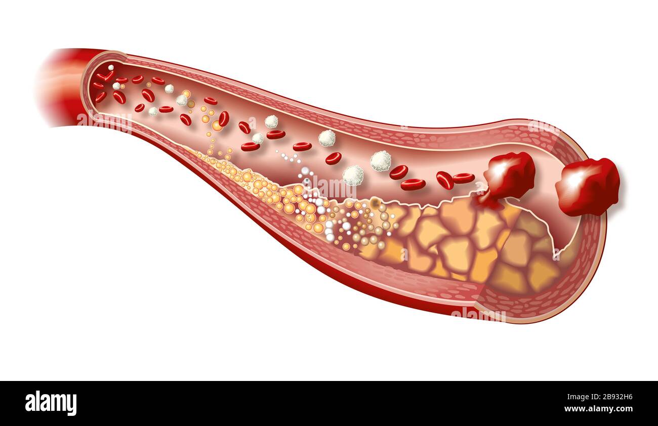 3D-Darstellung der Arterie mit weißen und roten Blutkörperchen, Cholesterin, Lipden, Kalzium und gestörter Plaque mit Thrombus Stockfoto
