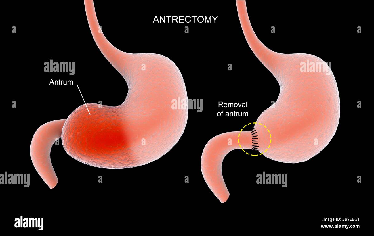 Abbildung: Verfahren zur Antrektomie des menschlichen Magens. Stockfoto