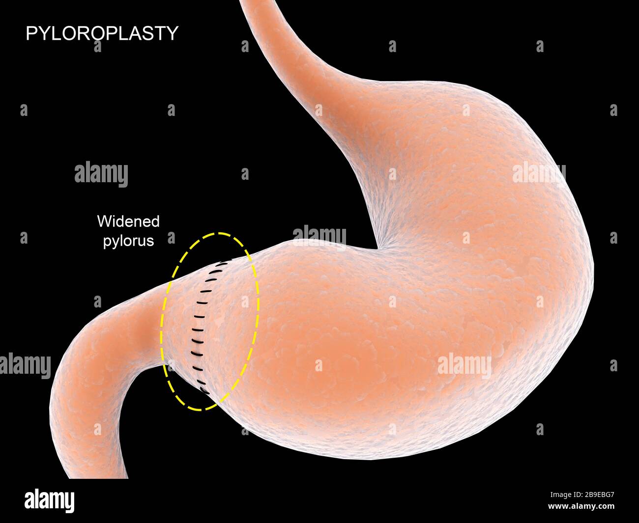 Medizinische Darstellung mit Pyloroplastie, die den Pylorus im Magen verbreitert. Stockfoto