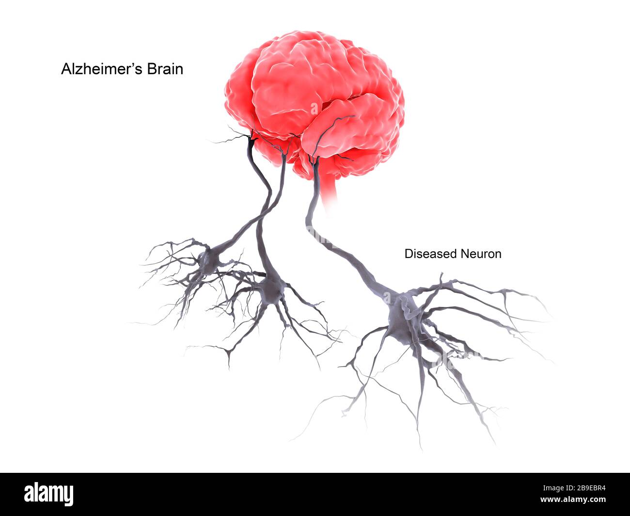 Ein Gehirn mit alzheimer-krankheit, das erkrankte Neuron zeigt. Stockfoto
