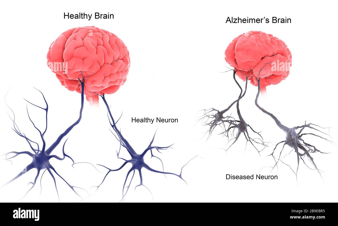 Vergleich eines gesunden Gehirns und eines Gehirns mit alzheimer. Stockfoto
