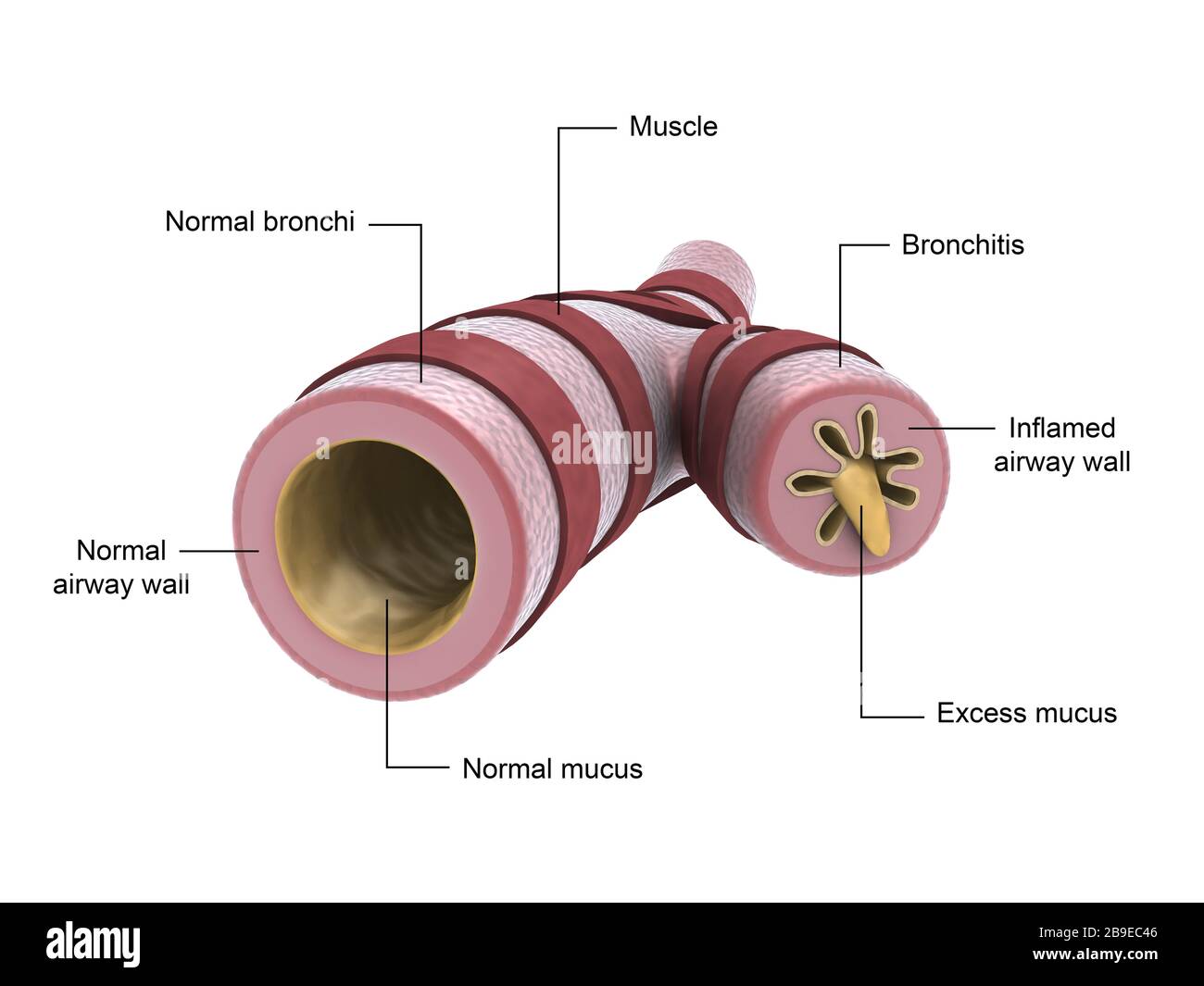 Medizinische Darstellung der Bronchitis. Stockfoto