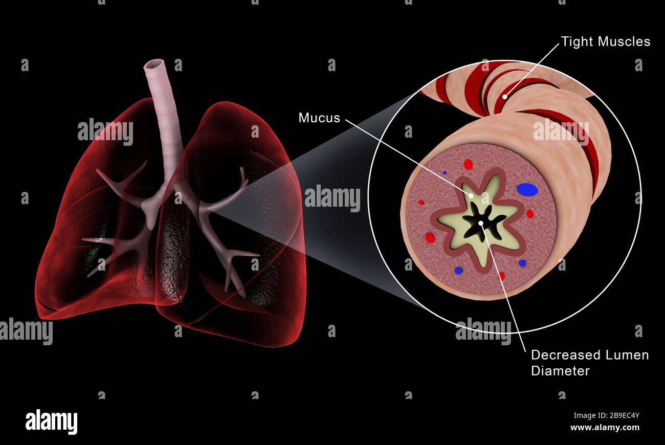 Medizinische Veranschaulichung einer asthmatischen Bronchiole in der menschlichen Lunge. Stockfoto