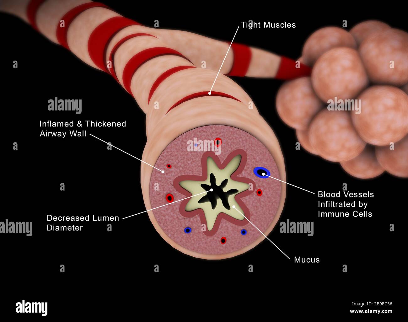 Medizinische Illustration einer asthmatischen Bronchiole mit Etiketten. Stockfoto