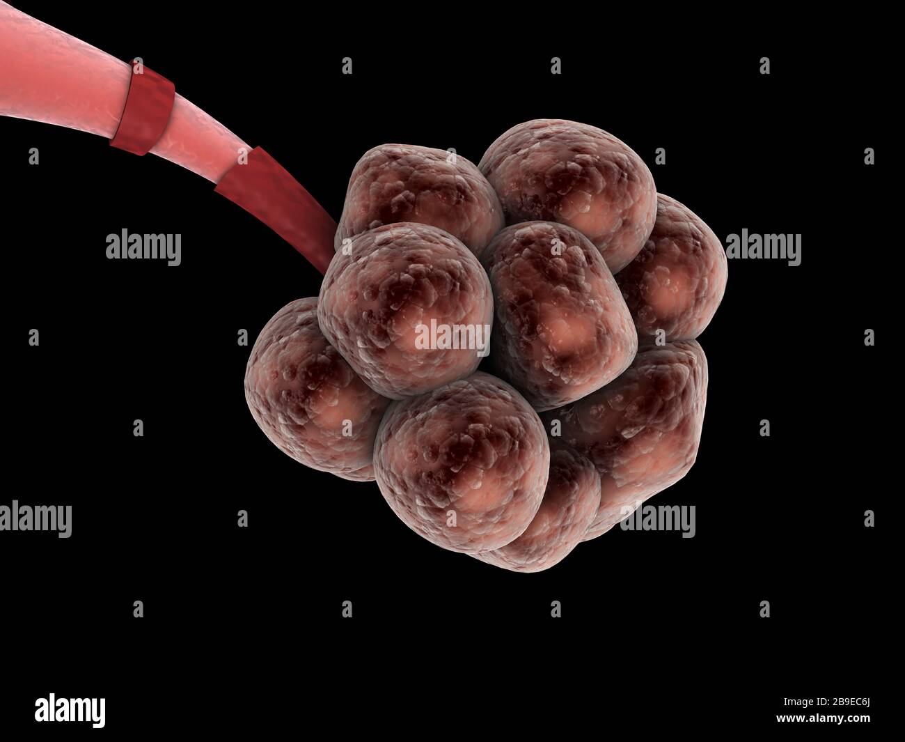 Medizinische Nahaufnahme des Emphysems in den Alveolen. Stockfoto
