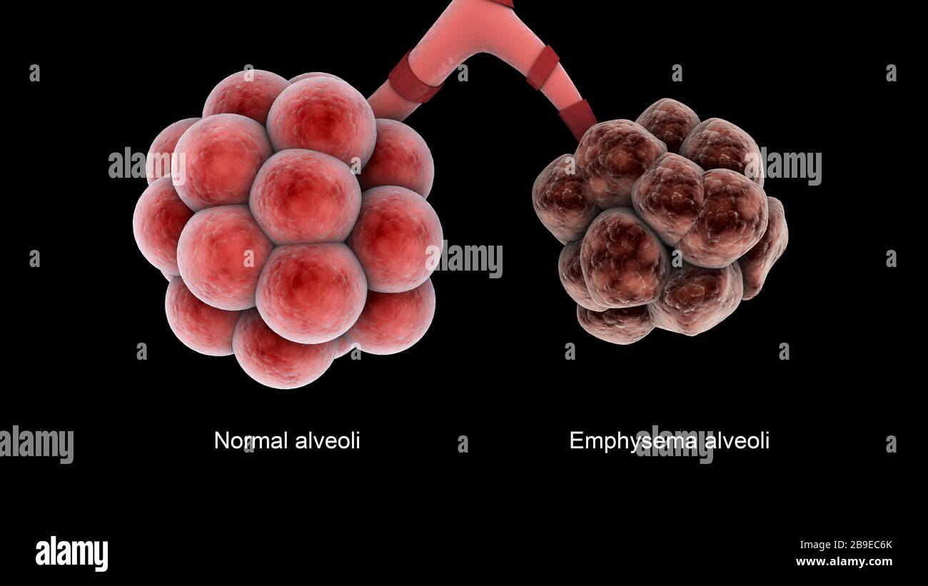 Medizinischer Vergleich von gesunden Alveolen und einem ungesunden Emphysem Alveoli. Stockfoto