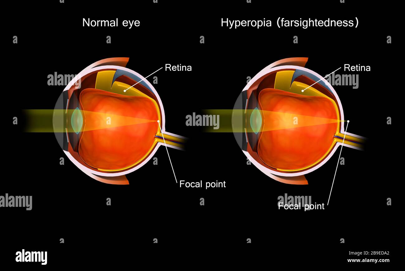 Vergleich eines normalen Auges und eines Auges mit Hyperopie. Stockfoto