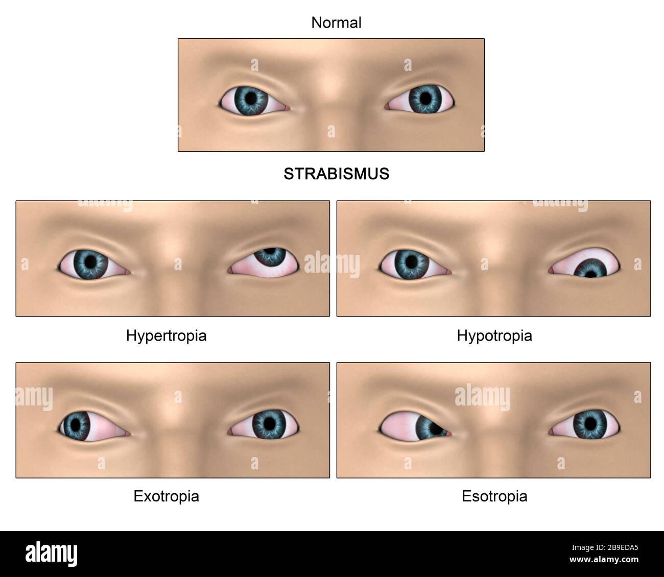 Strabismus-Diagramm, eine Bedingung, bei der die Augen nicht richtig aufeinander ausgerichtet sind. Stockfoto