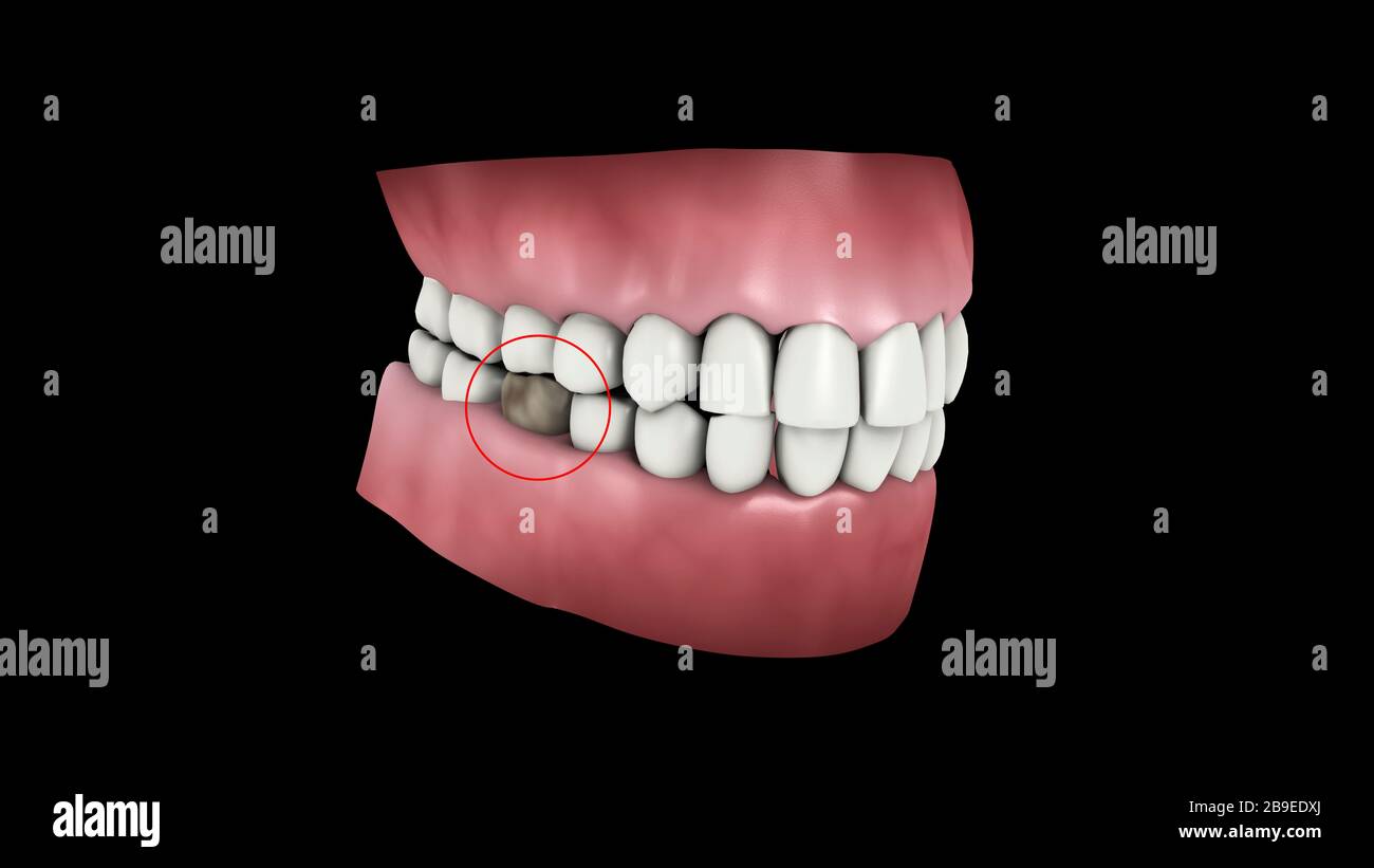 Medizinische Darstellung einer Zahnhöhle. Stockfoto