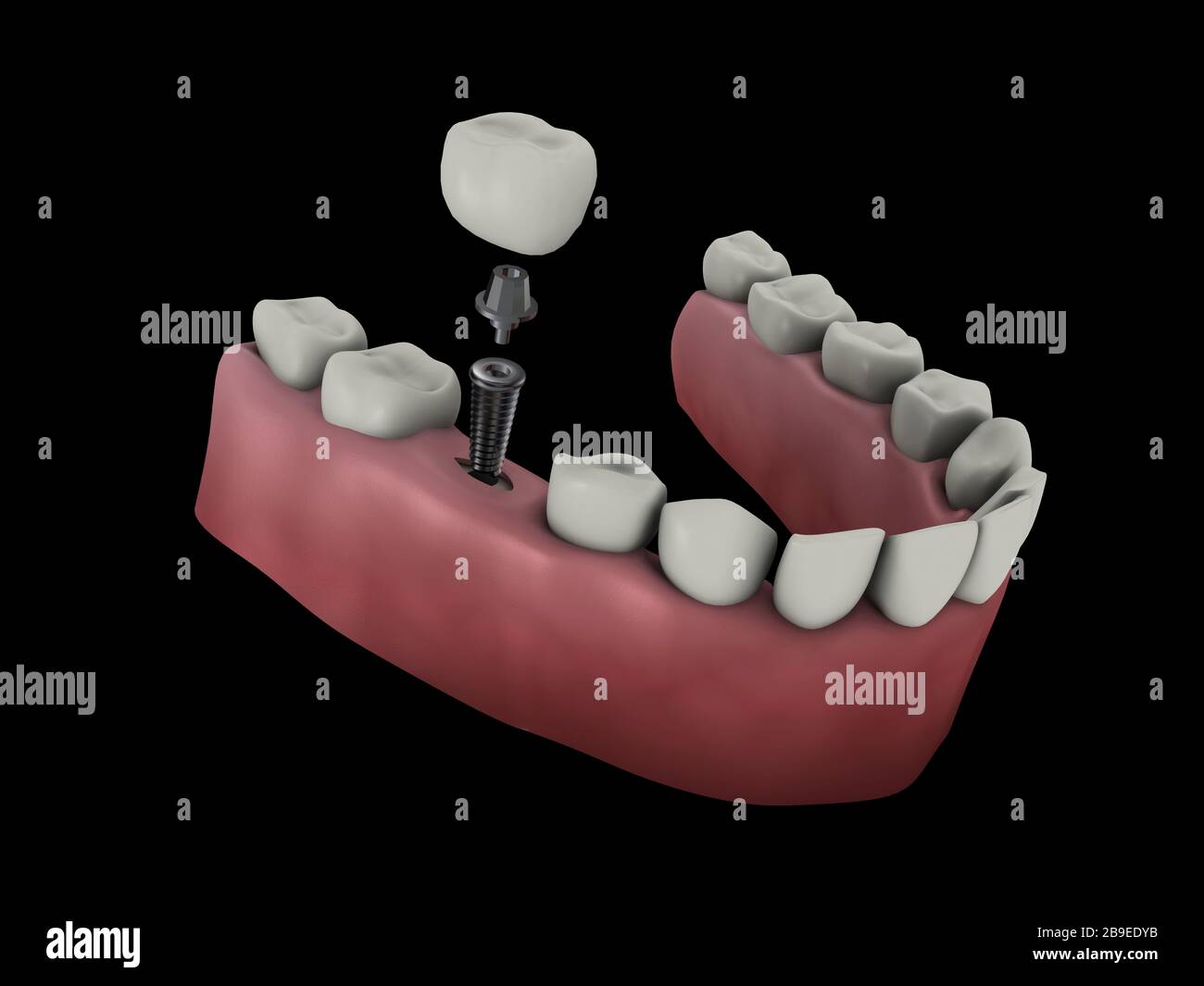 Medizinische Darstellung eines Zahnimplantats. Stockfoto