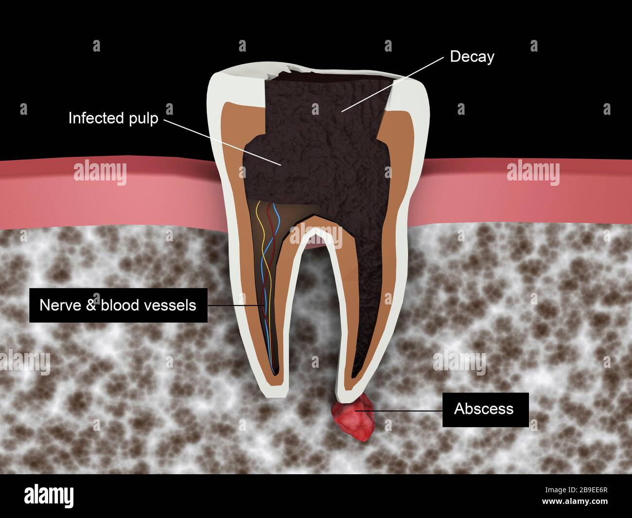 Cutaway-Ansicht einer Zahnhöhle. Stockfoto