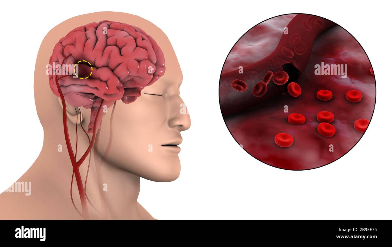 Medizinische Darstellung eines hämorrhagischen Schlaganfalls im Gehirn. Stockfoto