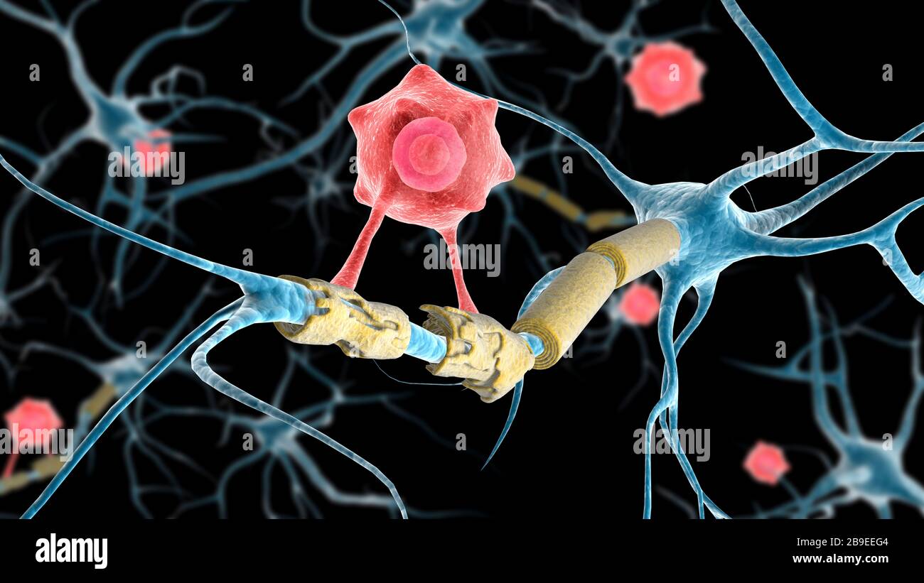 Konzeptionelles Bild eines Multiplen Sklerose-Neurons, das von einer T-Zelle geheilt wird. Stockfoto