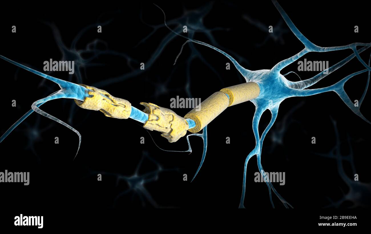 Konzeptionelles Bild eines Multiplen Sklerose-Neurons. Stockfoto
