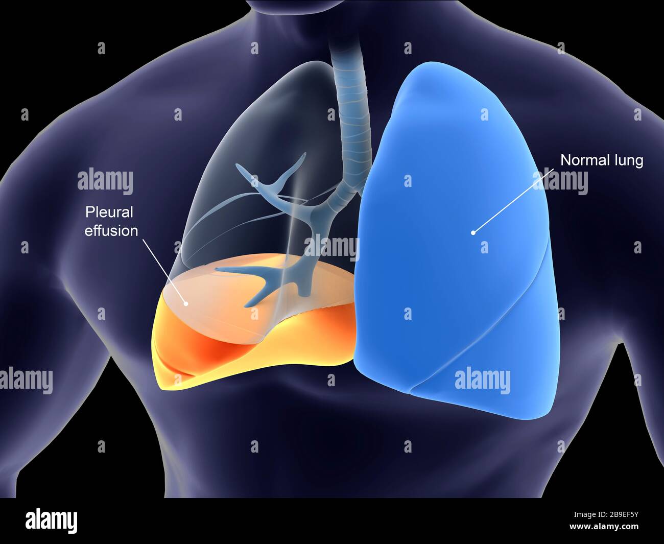 Medizinische Darstellung der Pleurisie in der menschlichen Lunge. Stockfoto