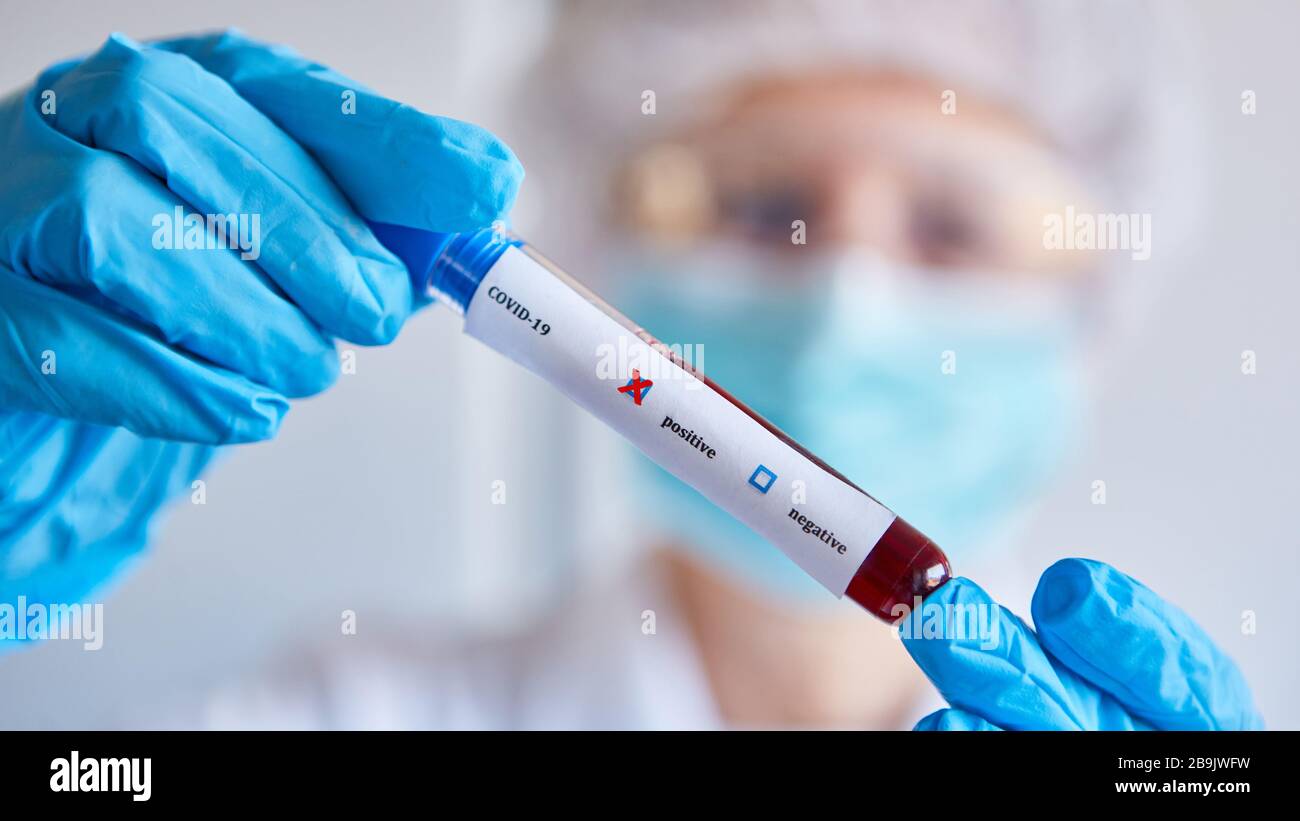 Medizinischer Mitarbeiter mit Blutprobe im Labor positiv für den Covid-19-Test Stockfoto