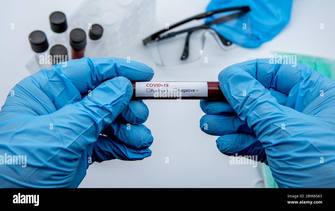 COVID-19-Test und Laborprobe von Blutuntersuchungen zur Diagnose einer neuen Corona-Virusinfektion. Krankheit 2019 aus Wuhan. Pandemic Infektionskonzept Stockfoto