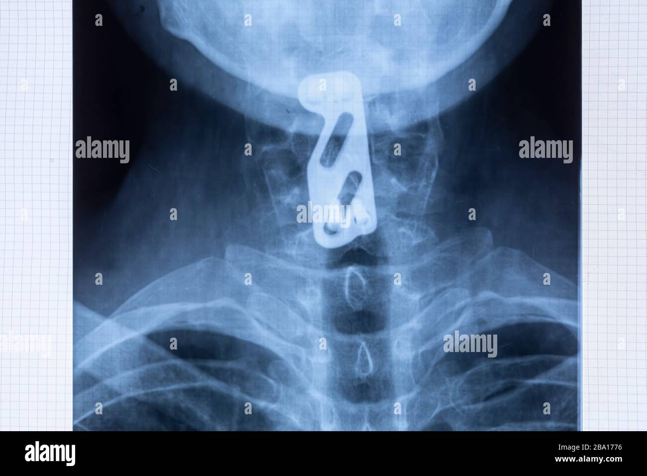 Radiographie der Titan-Platte-Fixierung zur Unterstützung der Halswirbelsäule nach C5- und C6-Wirbelverletzungen. Nackenstabilität mit Spinalinstrumenta Stockfoto