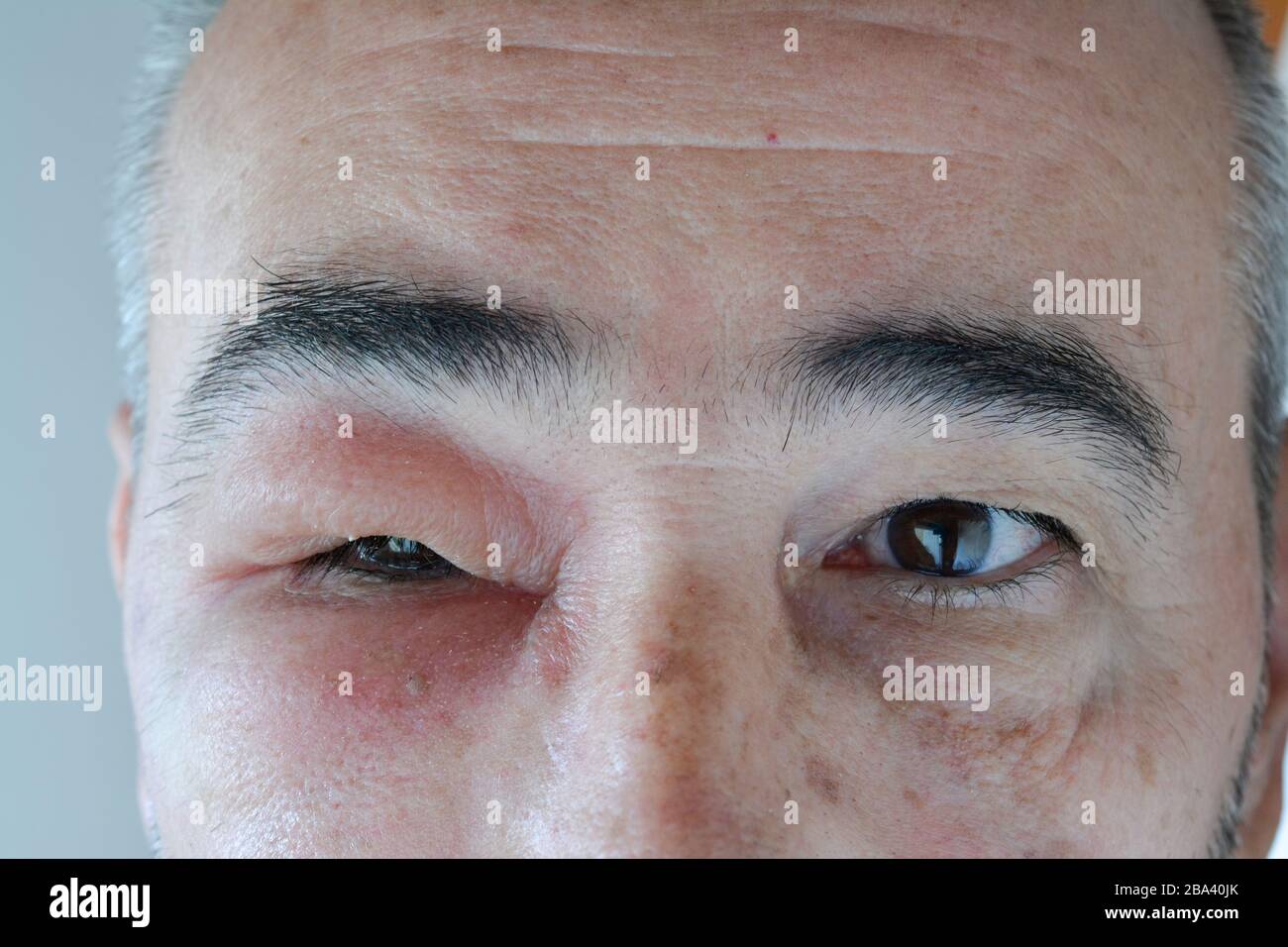 Gesicht eines Mannes mittleren Alters mit geschwollenem Auge aus dem Stacheln der Wespe, sichtbare Nekrose um die Injektionsstelle, Nahaufnahme Stockfoto