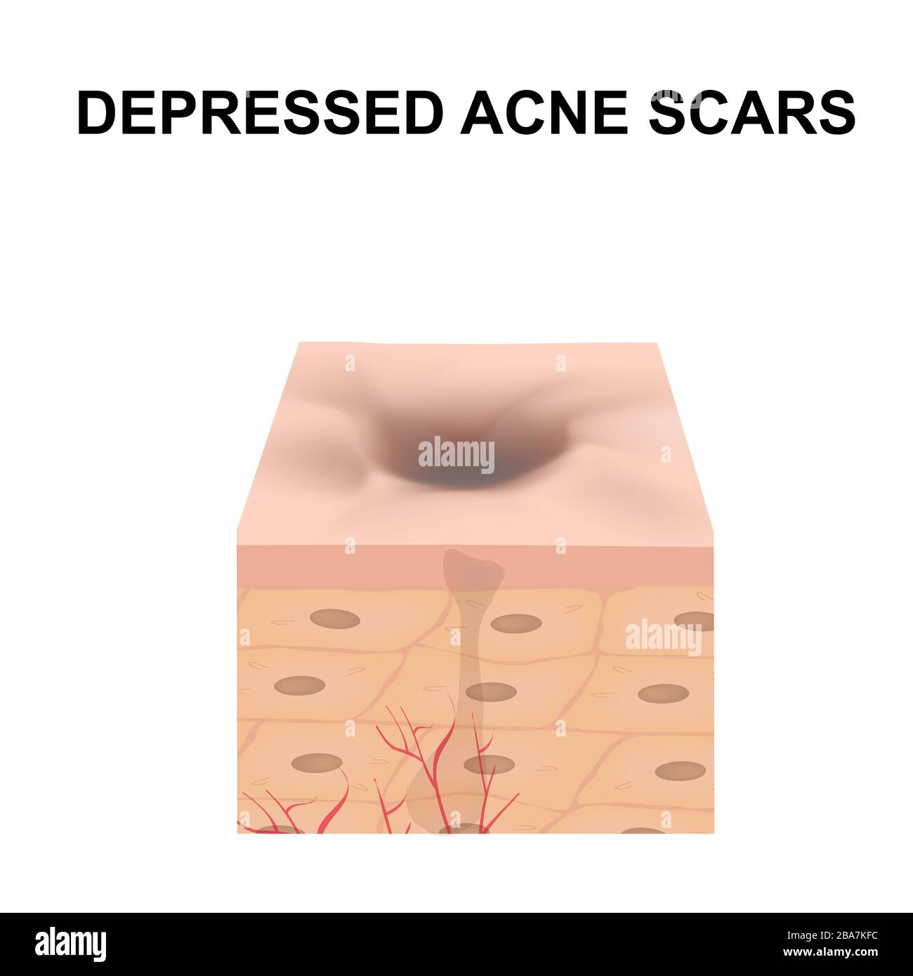 Atrophische Narben. Akne Narbe. Die anatomische Struktur der Haut mit Akne. Vector Illustration auf isolierte Hintergrund. Stock Vektor