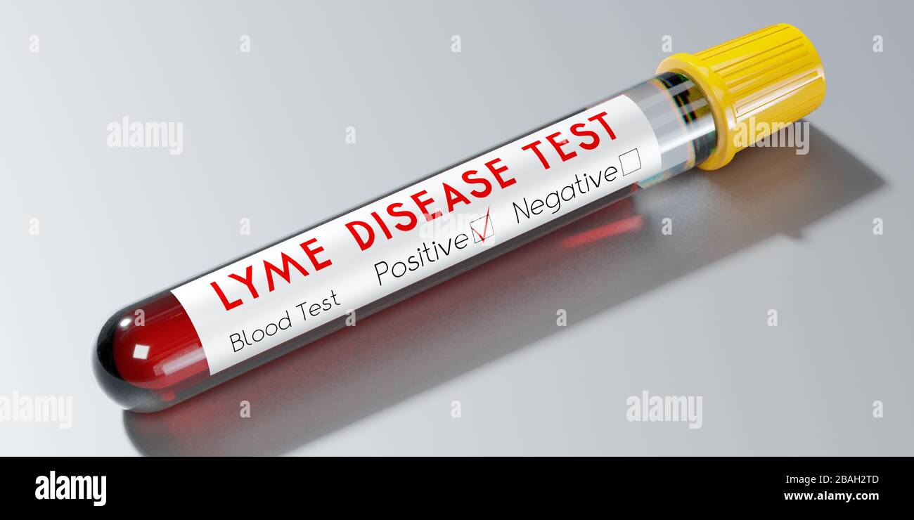 Lyme Disease Virus - Reagenzglas, Bluttest - 3D-Abbildung Stockfoto