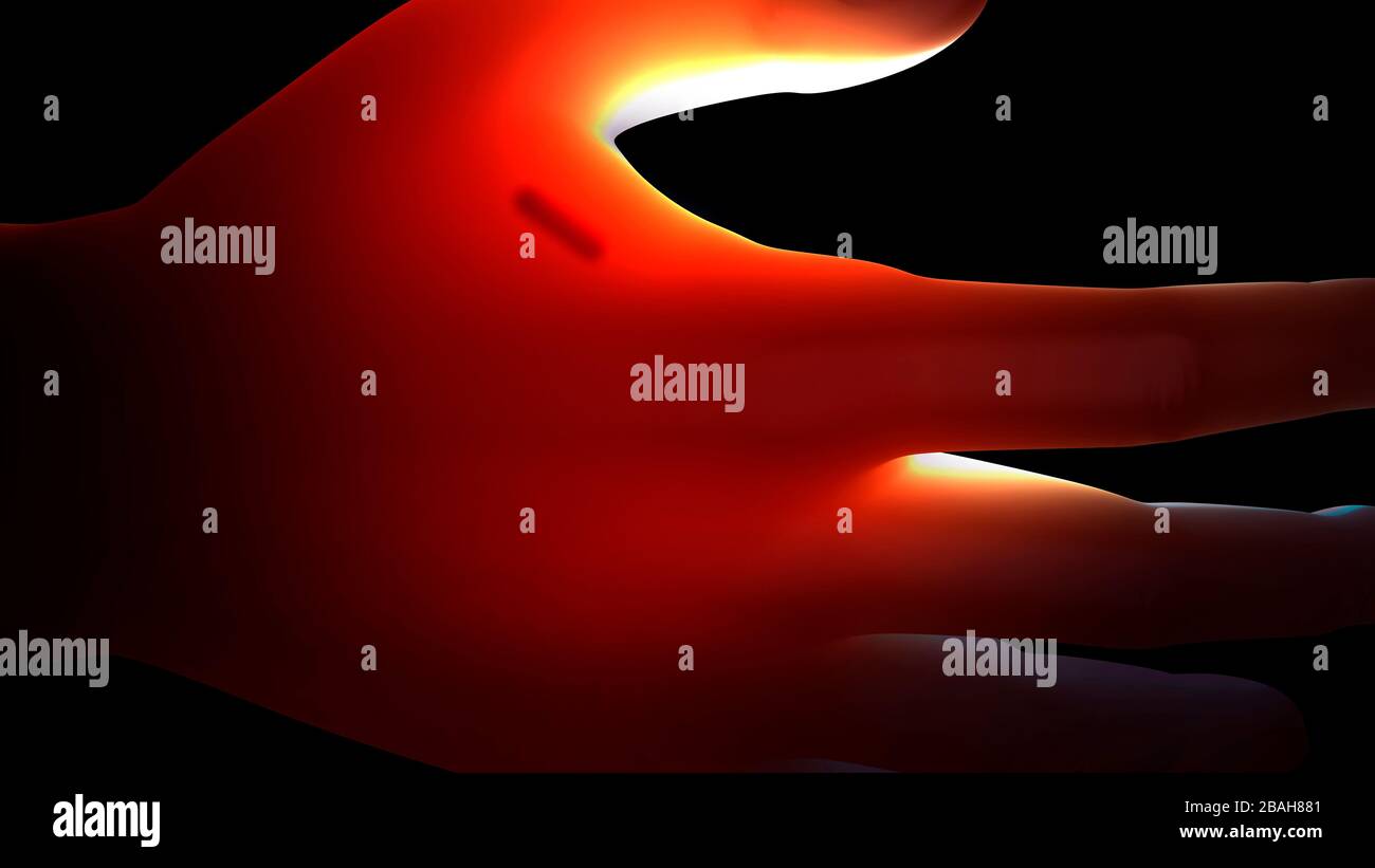 Mikrochip implantiert in menschlicher Hand, Abbildung Stockfoto