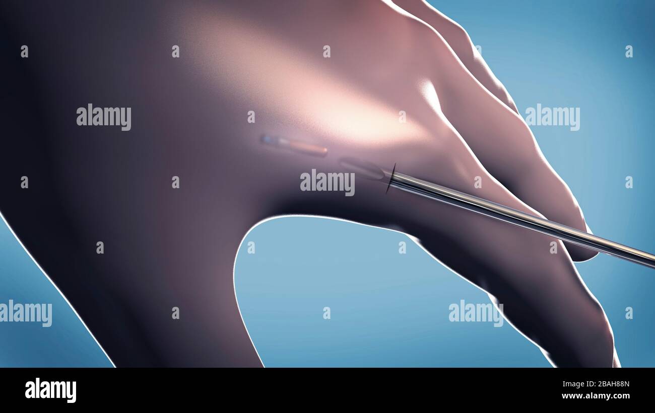 Mikrochip implantiert in menschlicher Hand, Abbildung Stockfoto