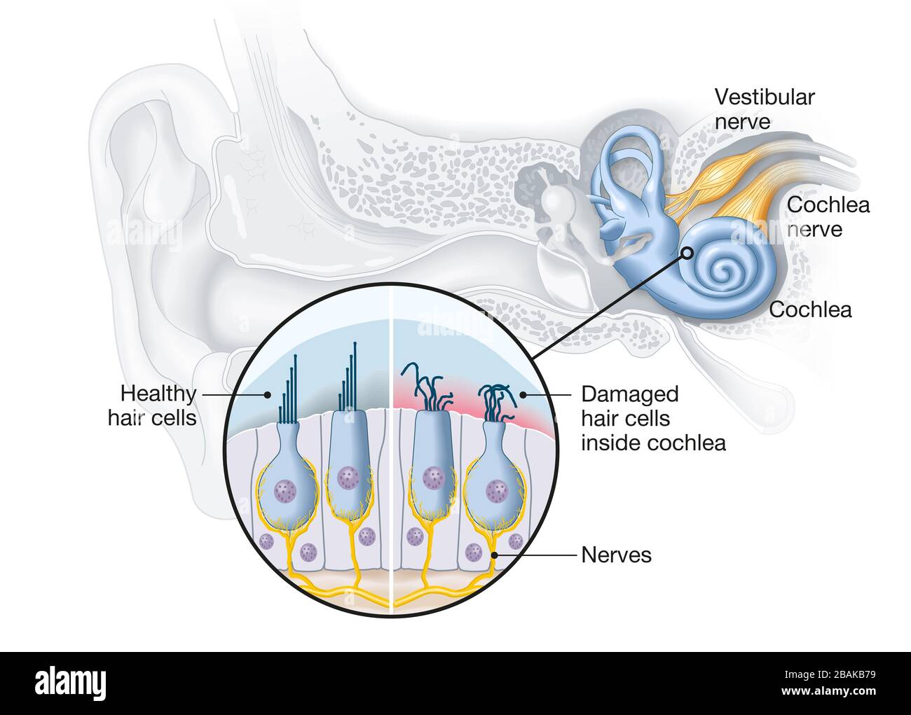 Gesunde und beschädigte Haarzellen im Inneren von Cochlea Stockfoto