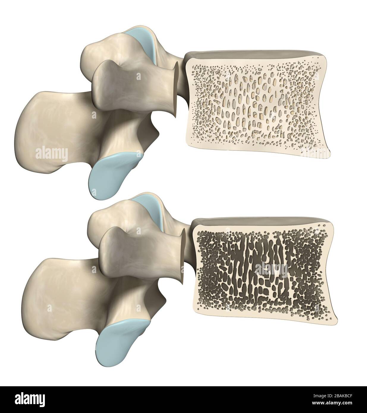 Oben: Gesunder Wirbelkörper und normale Knochenmatrix unten: Wirbelkörper mit Osteoporose, 3D-Abbildung Stockfoto