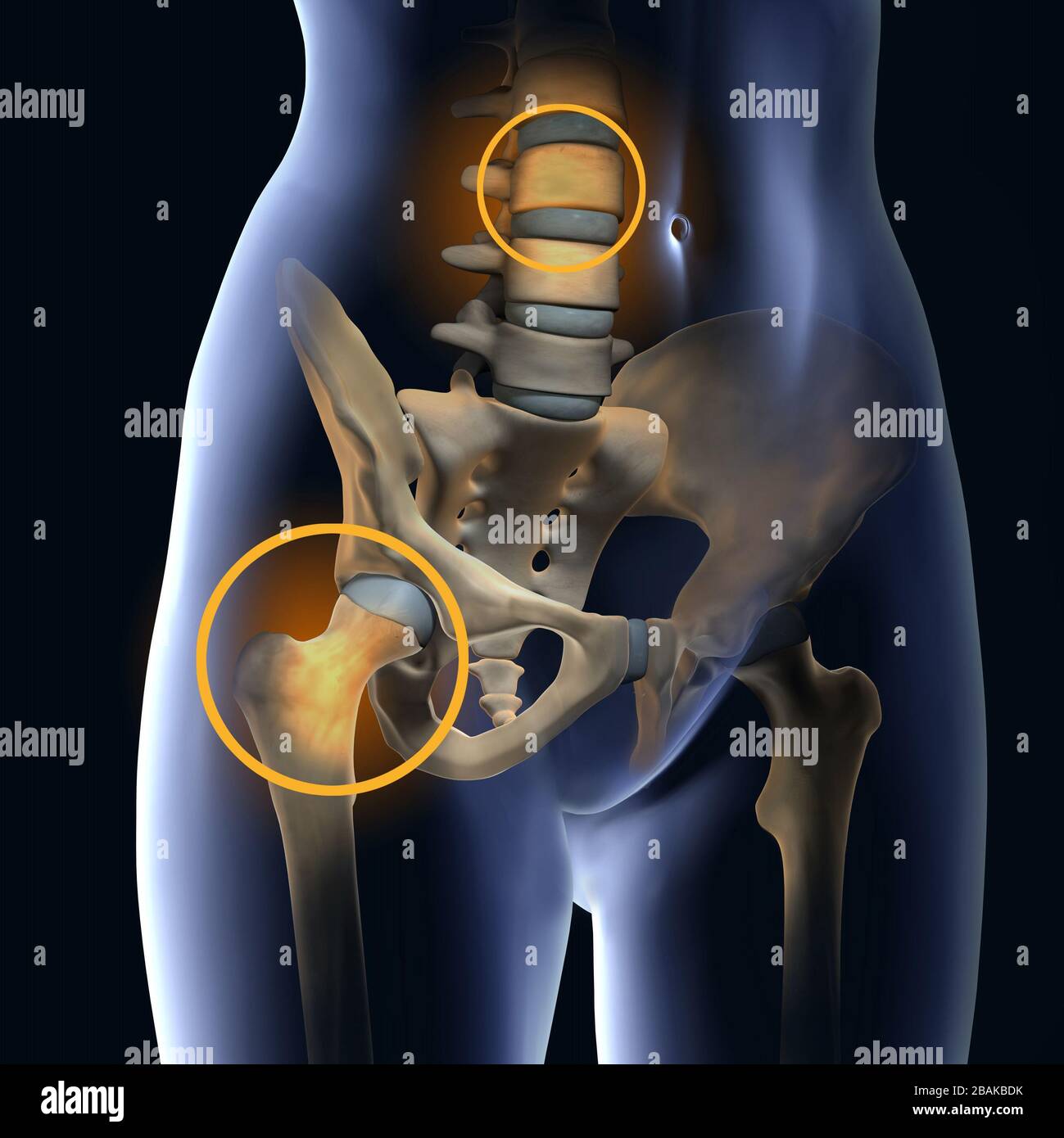 Frau mit Osteoporose, farbiger Fokus auf Hüftgelenk und Wirbelkörper, medizinische 3D-Darstellung Stockfoto